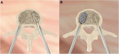 Porous titanium microsphere kyphoplasty for augmentation treatment of osteoporotic vertebral fractures: Technical report and case series